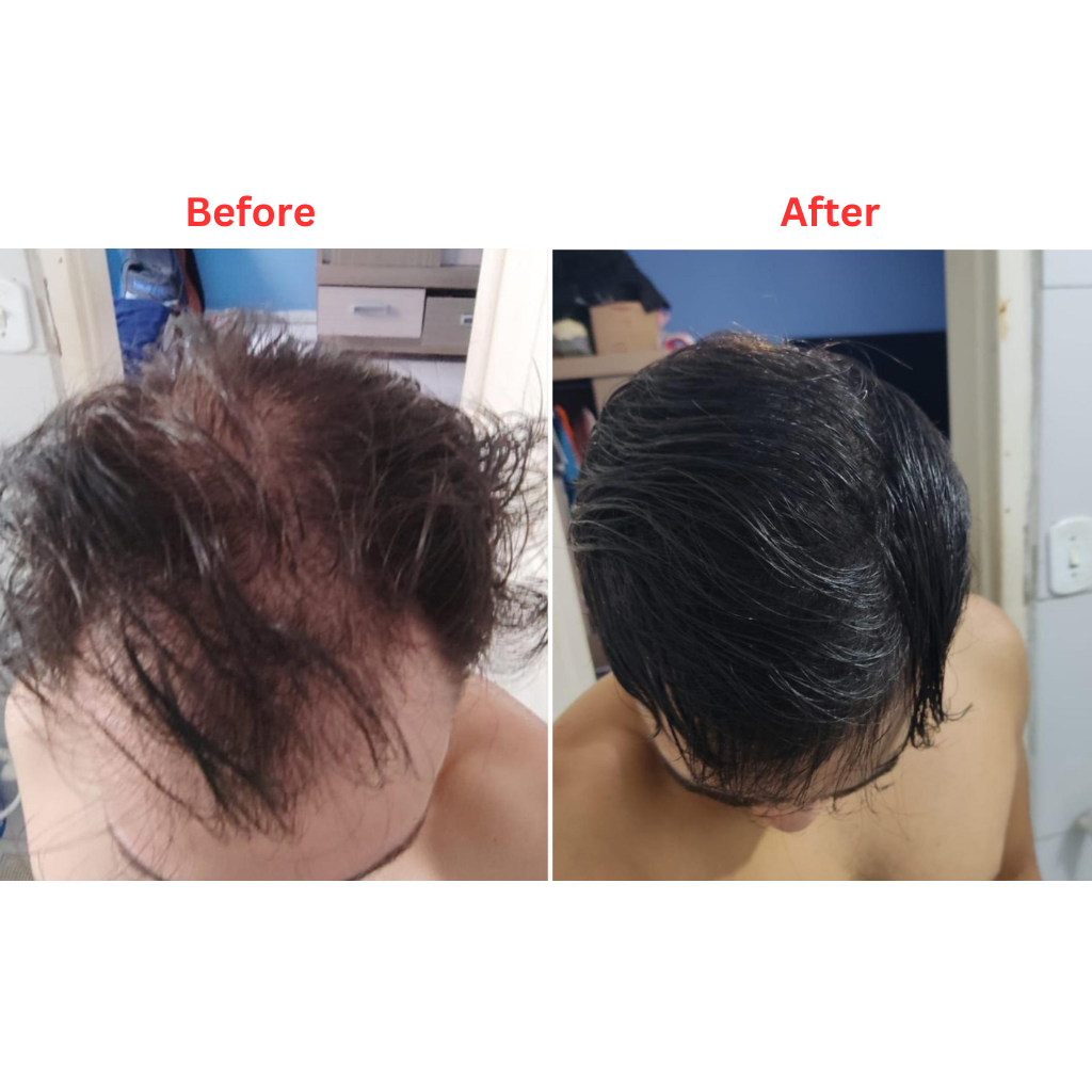 Microneedling pen for hair - 5 speed level - Regrow fuller, thicker hair, fix baldspots.